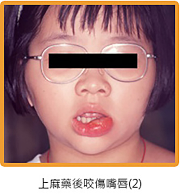胡桃鉗牙醫診所為什麼治療時要打麻藥