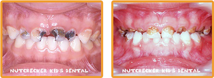 胡桃鉗牙醫診所認識奶瓶性齲齒